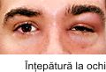 intepatura la ochi bee sting